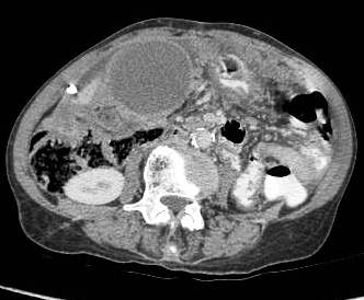 Figure 11: large fundal mass with invasion of colon and medially involving the gasro-hepatic ligament. Discrete peritoneal deposits can be seen.